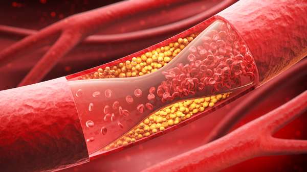 High Cholesterol: The First Steps In Lowering Your Cholesterol